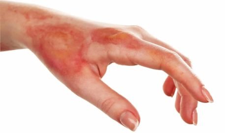 Skin burn