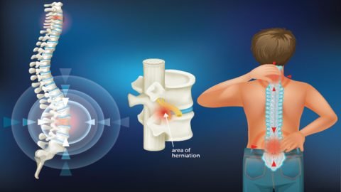 Spinal Cord Injury Patient