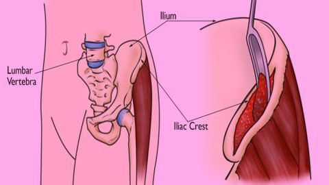 Iliac Crest Bone Marrow Aspiration and Grafting Site